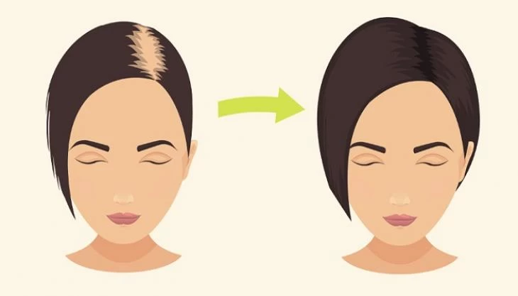 Πώς η μαγειρική σόδα σταματά την τριχόπτωση (βίντεο)